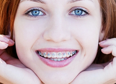 Niềng răng hô móm Niềng răng hô móm