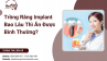 Trồng Răng Implant Bao Lâu Thì Ăn Được Bình Thường? Trồng Răng Implant Bao Lâu Thì Ăn Được Bình Thường?