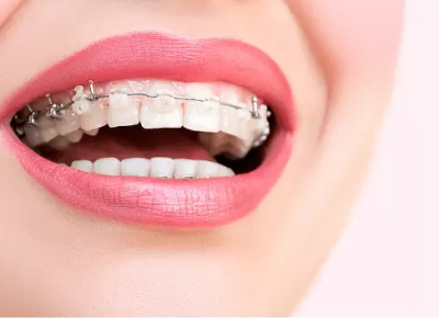 Chỉnh nha cố định Chỉnh nha cố định