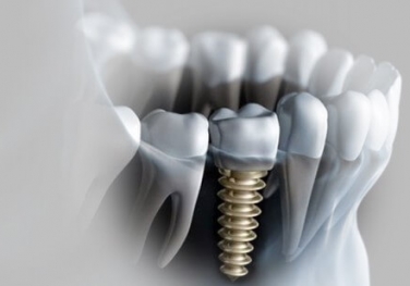 Cấy ghép Implant Cấy ghép Implant