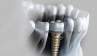 Cấy ghép Implant Cấy ghép Implant