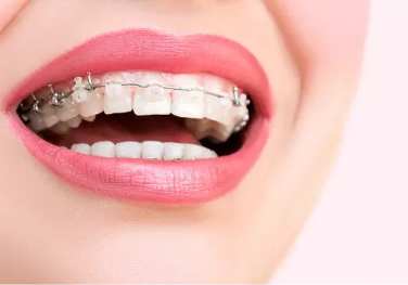 Chỉnh nha cố định Chỉnh nha cố định