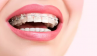 Chỉnh nha cố định Chỉnh nha cố định