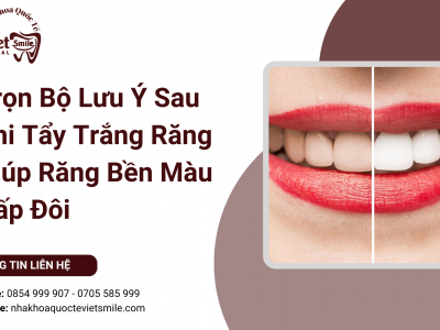 Trọn Bộ Lưu Ý Sau Khi Tẩy Trắng Răng Giúp Răng Bền Màu Gấp Đôi Trọn Bộ Lưu Ý Sau Khi Tẩy Trắng Răng Giúp Răng Bền Màu Gấp Đôi