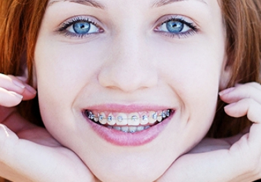 Niềng răng hô móm Niềng răng hô móm