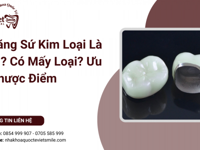 Răng Sứ Kim Loại Là Gì? Có Mấy Loại? Ưu Nhược Điểm Răng Sứ Kim Loại Là Gì? Có Mấy Loại? Ưu Nhược Điểm