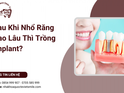 Sau Khi Nhổ Răng Bao Lâu Thì Trồng Implant? Sau Khi Nhổ Răng Bao Lâu Thì Trồng Implant?