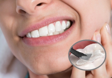 Trám răng Trám răng