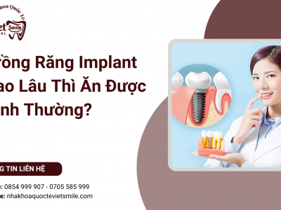 Trồng Răng Implant Bao Lâu Thì Ăn Được Bình Thường? Trồng Răng Implant Bao Lâu Thì Ăn Được Bình Thường?