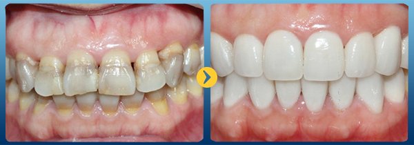 Bọc sứ thẩm mỹ cho răng nhiễm màu kháng sinh