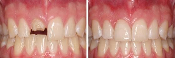 Mặt dán sứ cho răng cửa gãy, vỡ