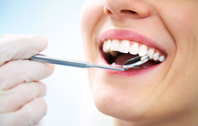 Cạo vôi răng là gì?