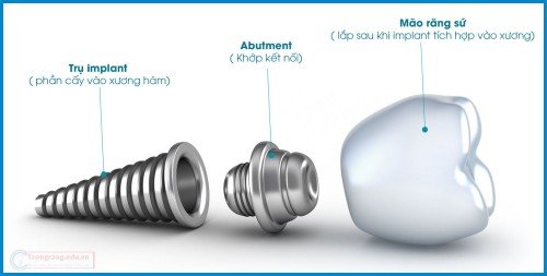 Cấu tạo của một chiếc răng implant