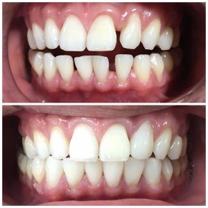 Những trường hợp nào nên dán sứ thẩm mỹ