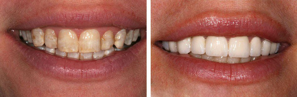 Tẩy trắng răng truyền thống