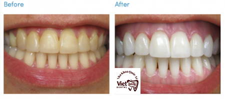 dịch vụ tẩy trắng răng Quảng Bình